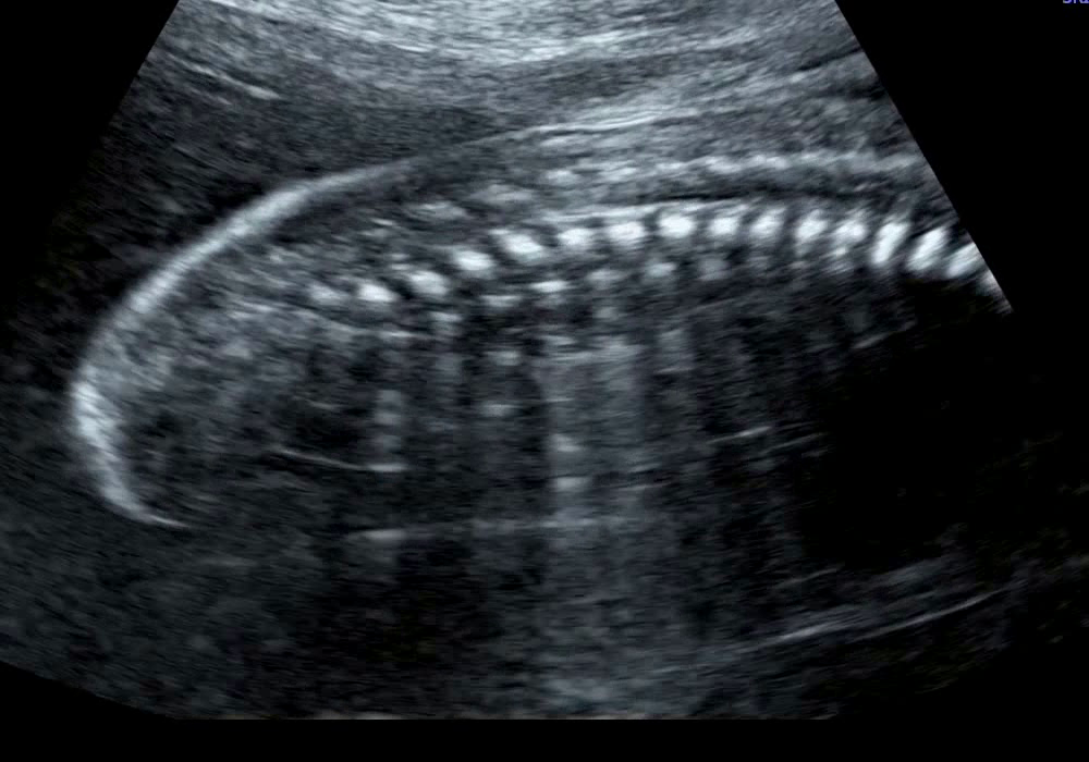 胎儿脊髓圆锥超声图片图片
